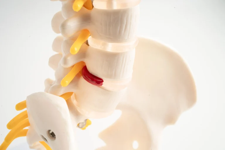 slip disc chiropractic slip disc bone closeup tio chiro