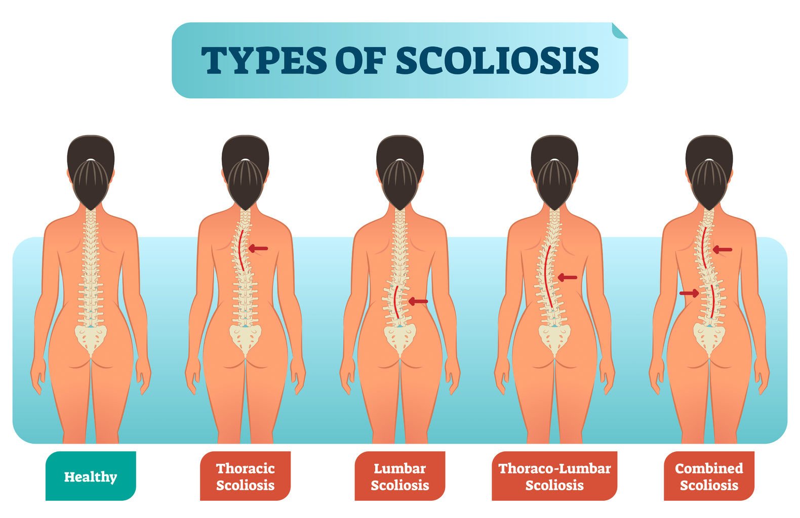 scoliosis treatment