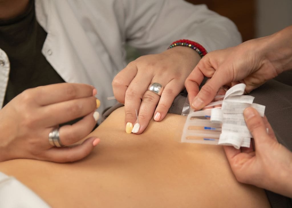 Woman getting dry needling treatment at Petaling Jaya.