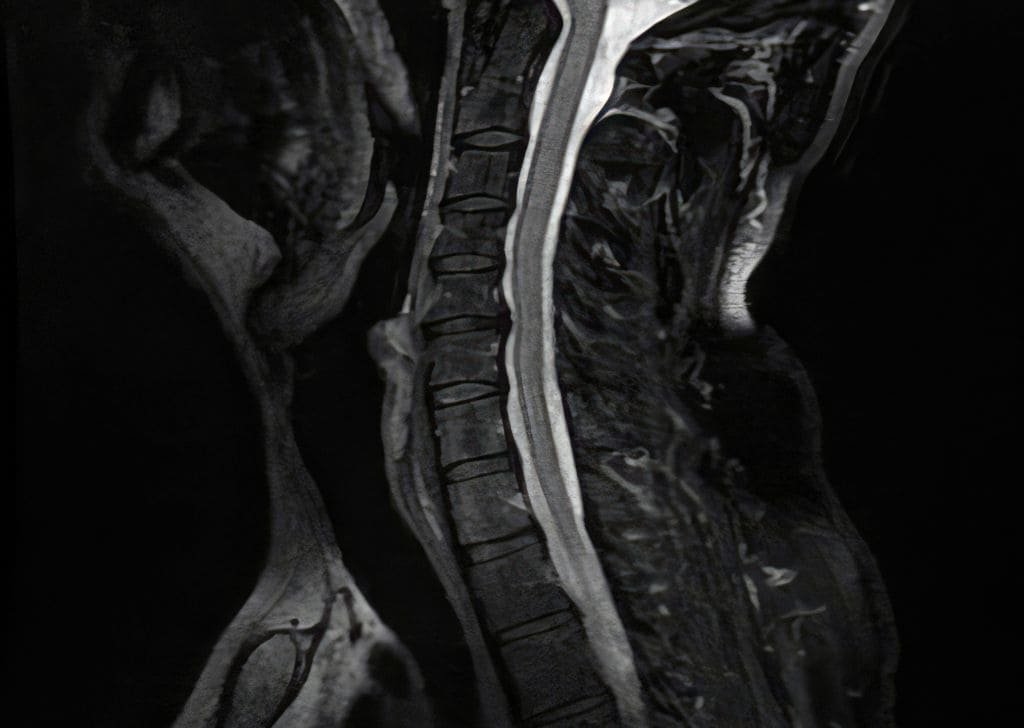 X-rays are used to determine how to heal from a herniated disc.