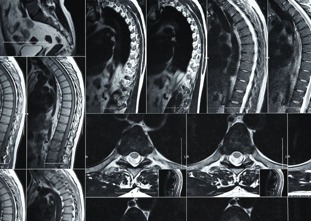 X-ray showing patient's spine.