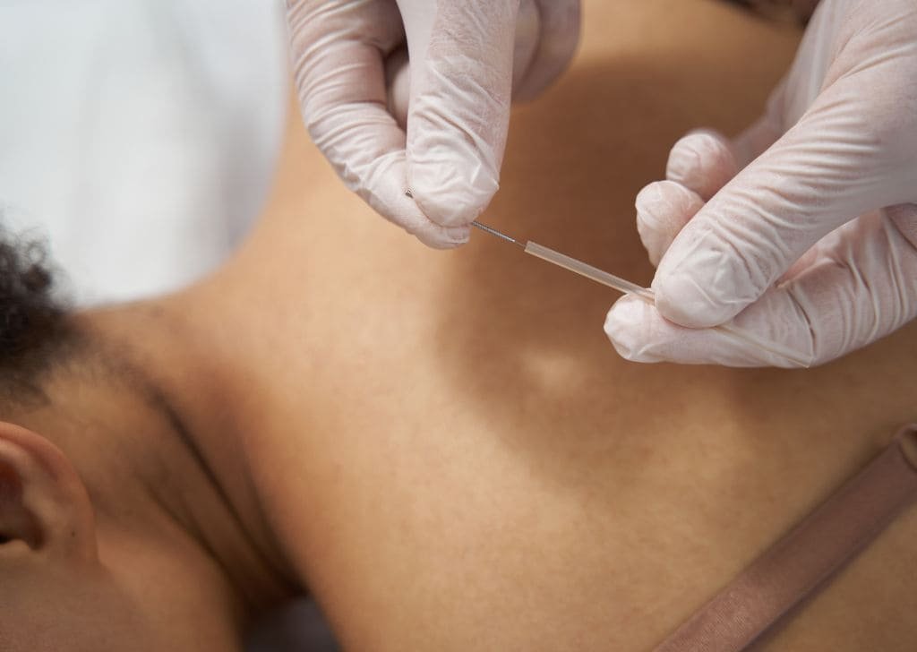 Medical practitioner preparing a dry needling treatment for the patient.  