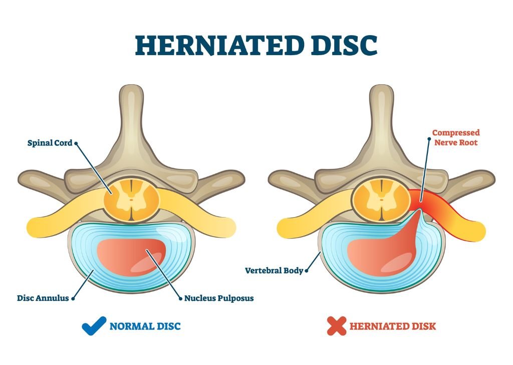 Infographic of a herniated or slipped disc at Petaling Jaya, Tio Chiro & Physio.
