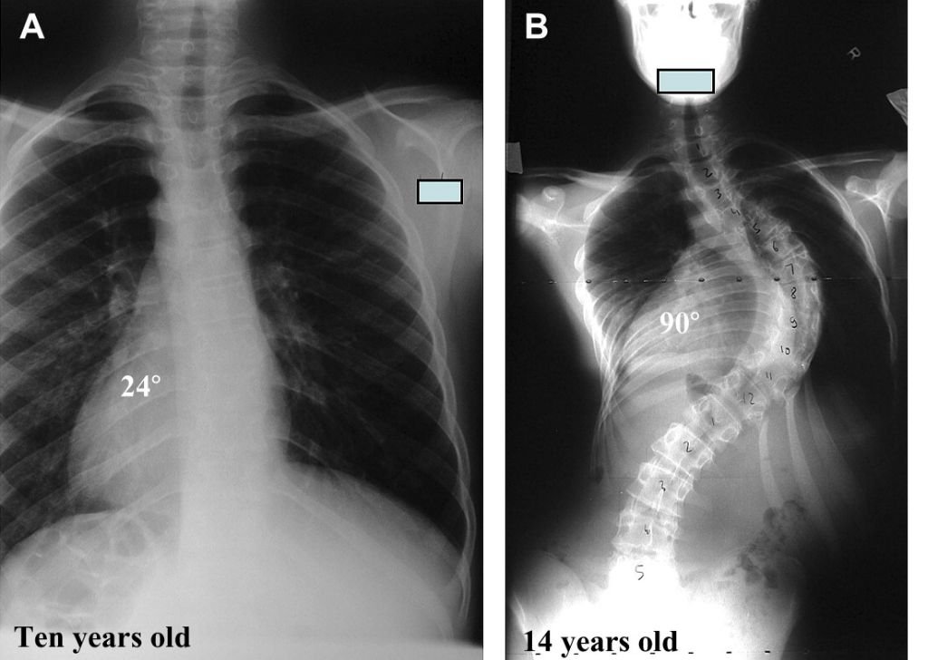 A sample X-ray of Idiopathic scoliosis from a chiropractor in Petaling Jaya, Tio Chiro Physio.