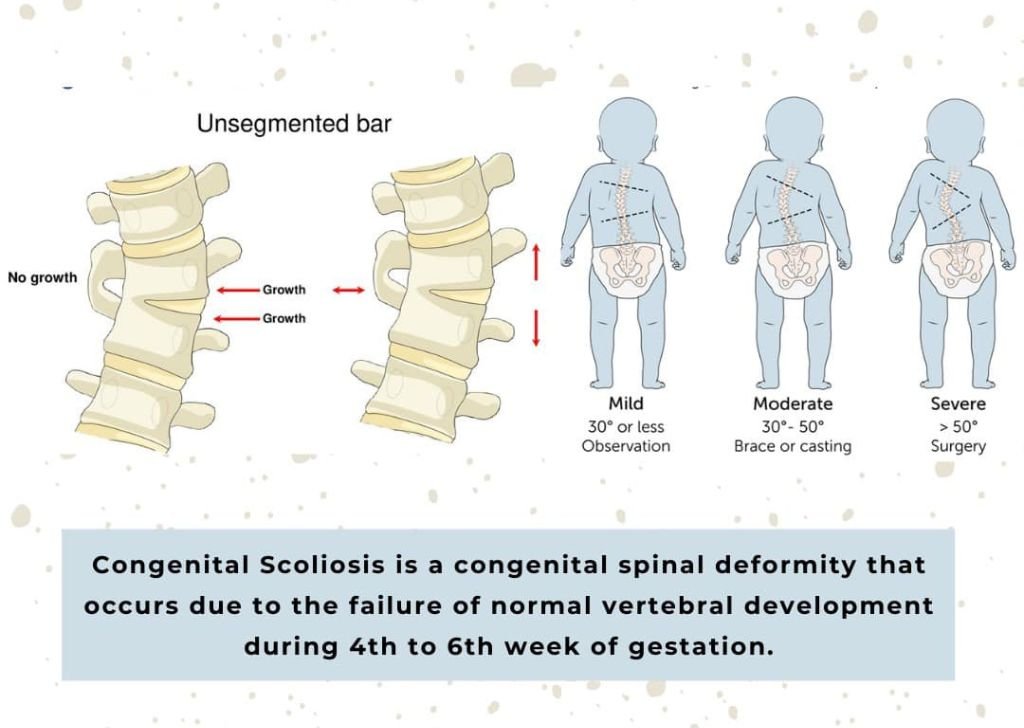 An infographic of congenital scoliosis from a chiropractor in Petaling Jaya, Tio Chiro Physio.