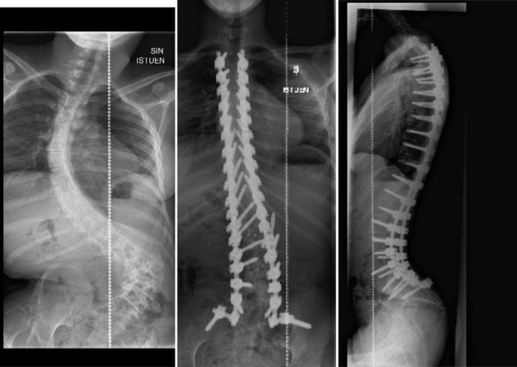 A sample X-ray of neuromuscular scoliosis from a chiropractor in Petaling Jaya, Tio Chiro Physio.