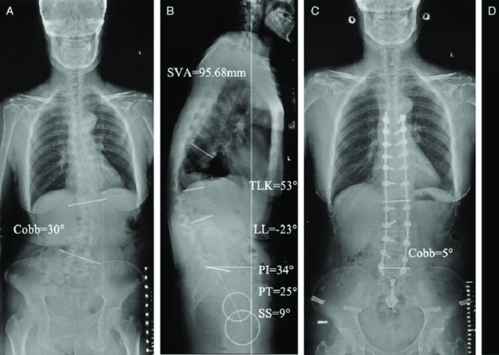 A sample X-ray of degenerative scoliosis from a chiropractor in Petaling Jaya, Tio Chiro Physio.
