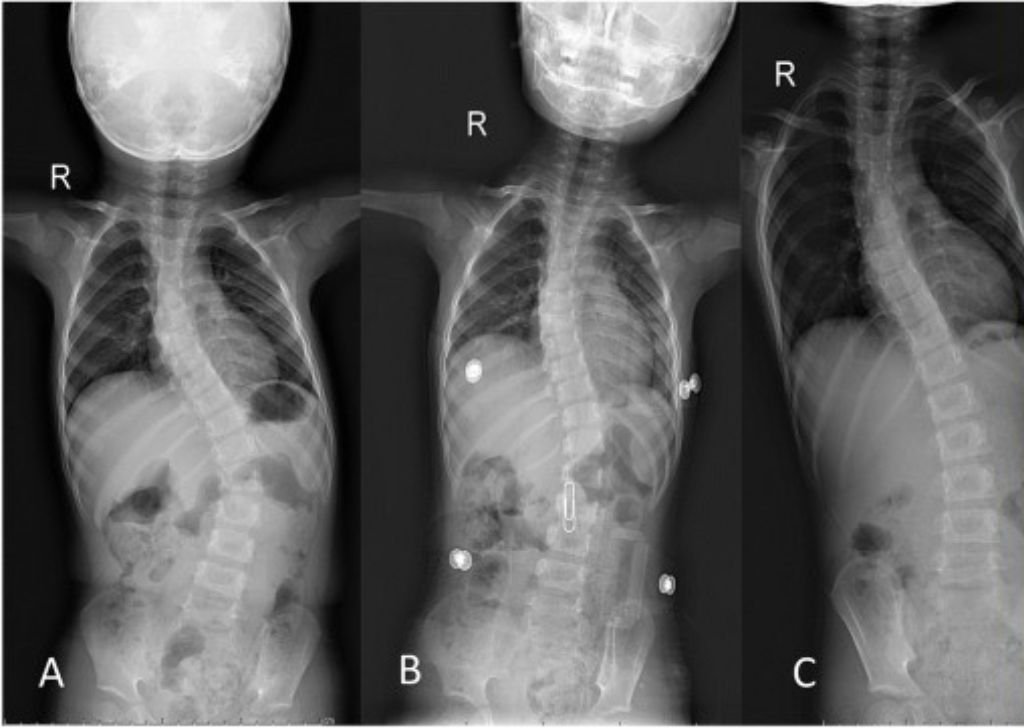 An x-ray of a child with scoliosis in Petaling Jaya.