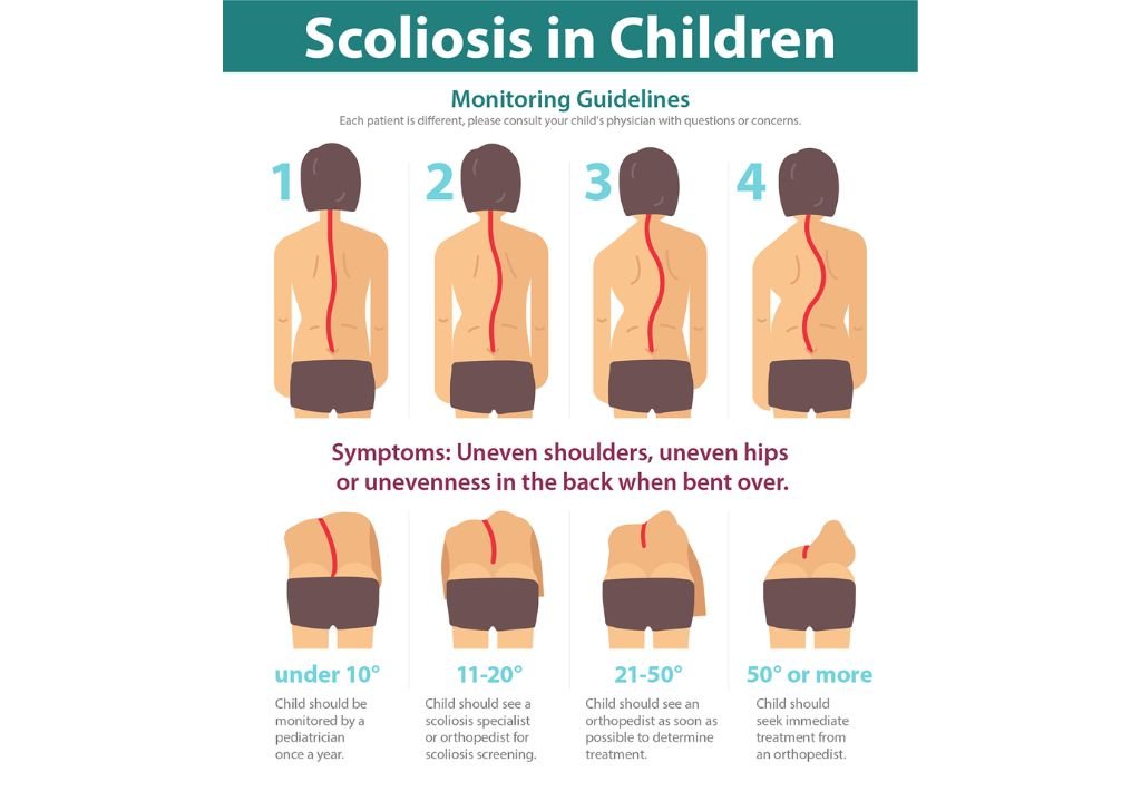 Scoliosis Infographic.