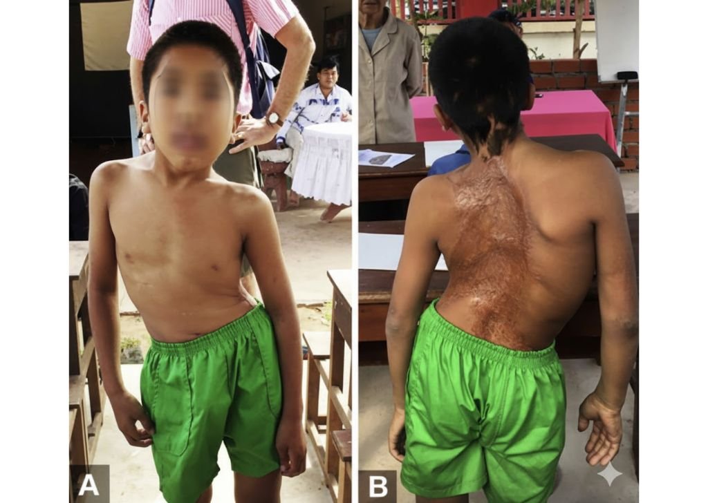 A child with a severe case of scoliosis.