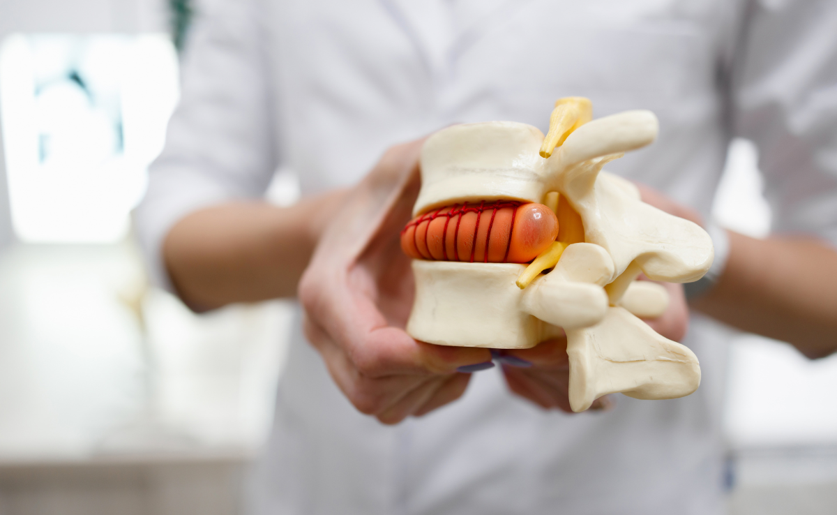 Doctor holds a model of a herniated disc