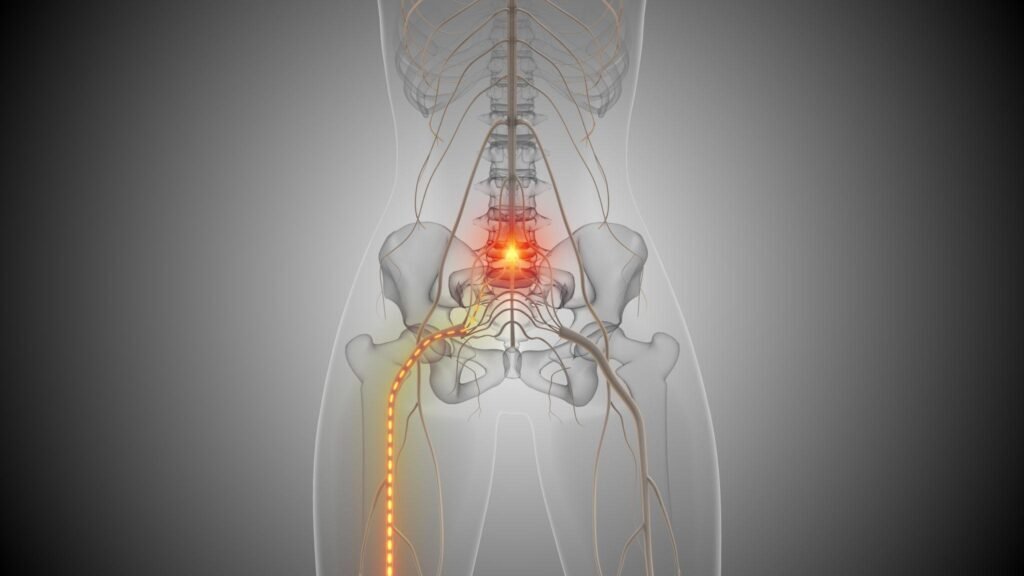 sciatica pain